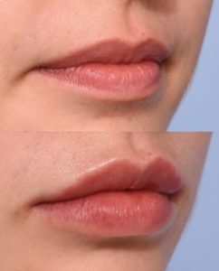 1.-Lippen-opvullen.jpg