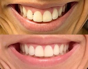4.-Liplift.jpg