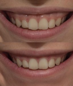 6.-gummy-smile.jpg