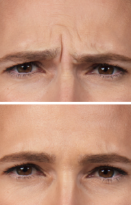 7.-Fronsrimpels.png