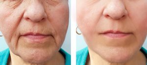 5c2770524fdbba19a3c19b0a_fillers marionette lines