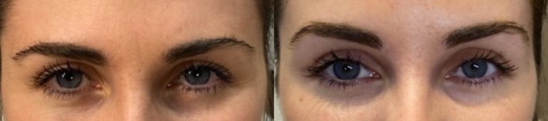 Botox-Browlift-Phoenix-Arizona-1