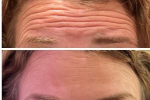 Botox Forehead 1 - 12-23
