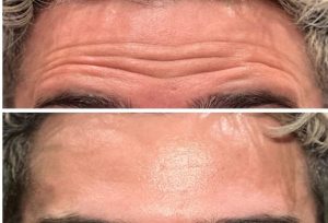 Botox Forehead 7 - 12-23