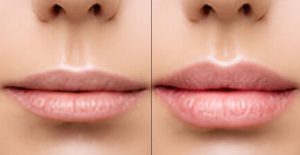 Botox-Lip-Flip-Dubai-1