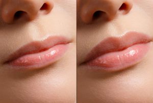 Botox-Lip-Flip-Dubai-2