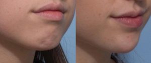 Dermal-filler-chin-sydney