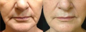 Fillers-For-Lines-Around-Mouth-Laugh-Lines-14189-67yo-Caucasian-Woman-CROPPED-Front-BeforeandAfter