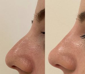 Nose-filler-before-and-after-1-2048x1610