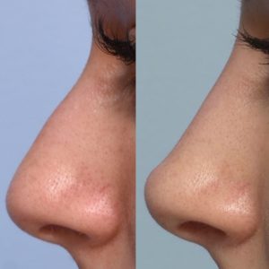 before-and-after-nose-filler-1-1638x2048