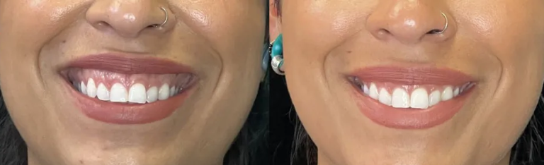 botox-GUMMY-SMILE-976W