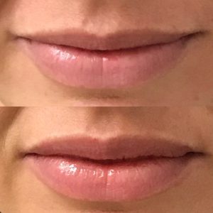 botox-lip-flip-santa-rosa-novato-marin-napa-sonoma-1024x1024