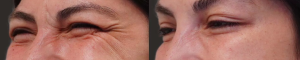 botox-procedure-crows-feet