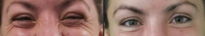 botox-procedure-crows-feet-wrinkles