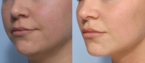 chin-filler-and-fat-dissolving--2048x1152