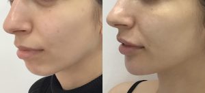 chin-jawline-and-lip-fillers-2048x1300
