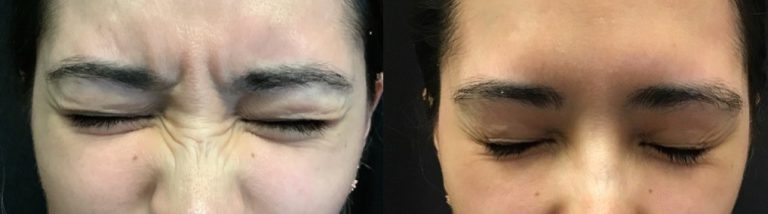 glabellar-bunny-ears-jeuvau