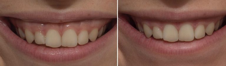 gummy-smile-botox-1638x2048