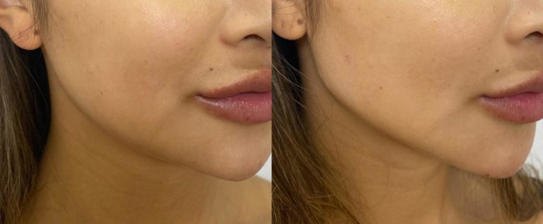 jawline-filler-before-and-after-2-2048x2048