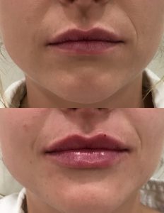 lip-fillers-before-and-after-1638x2048