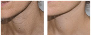 neck-wrinkles-before-and-after
