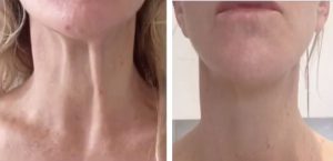 nefertiti-lift-799x800