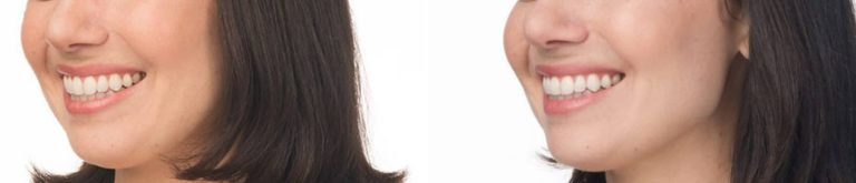 new-beauty-wellness-botox-before-after-11