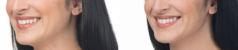 new-beauty-wellness-botox-before-after-14