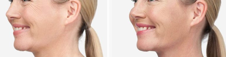 new-beauty-wellness-botox-before-after-9