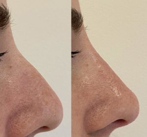 non-surgical-nose-job-before-and-after-2048x1620